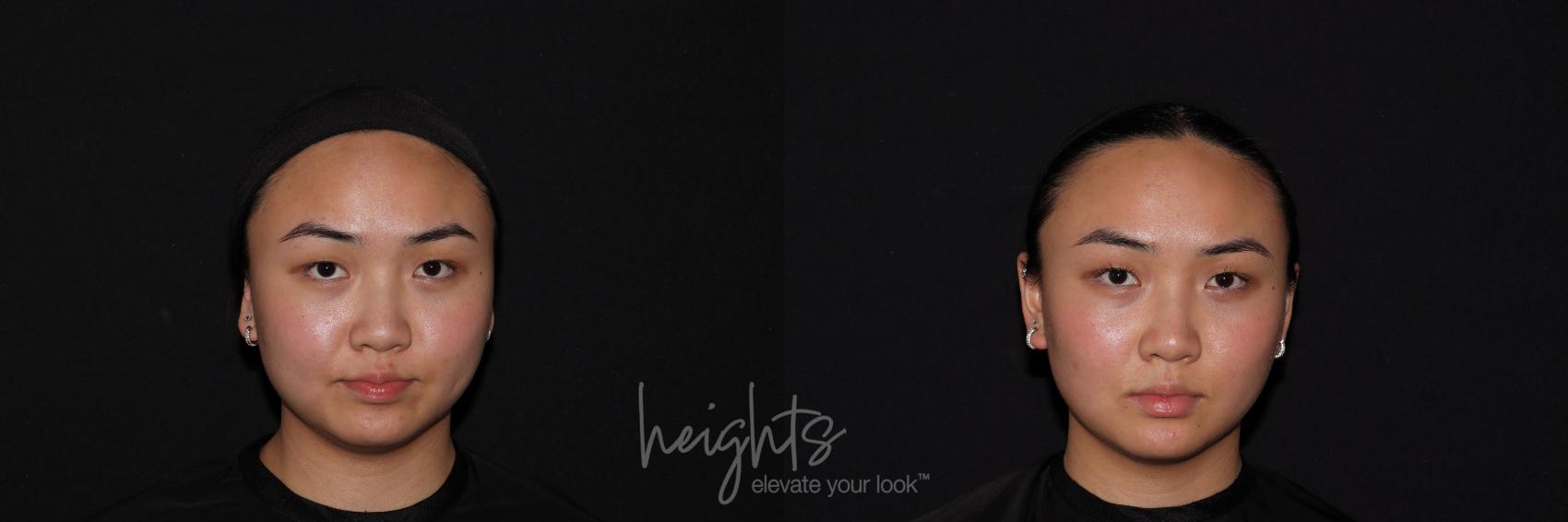 Before & After Belkyra™ Double Chin Treatment Case 121 Front View in Vancouver (Burnaby), BC