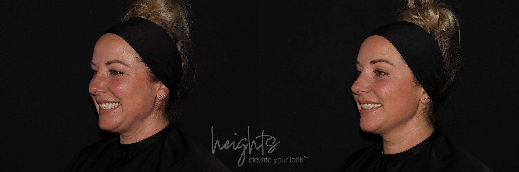 Before & After BOTOX COSMETIC® Case 125 Left Oblique View in Vancouver (Burnaby), BC