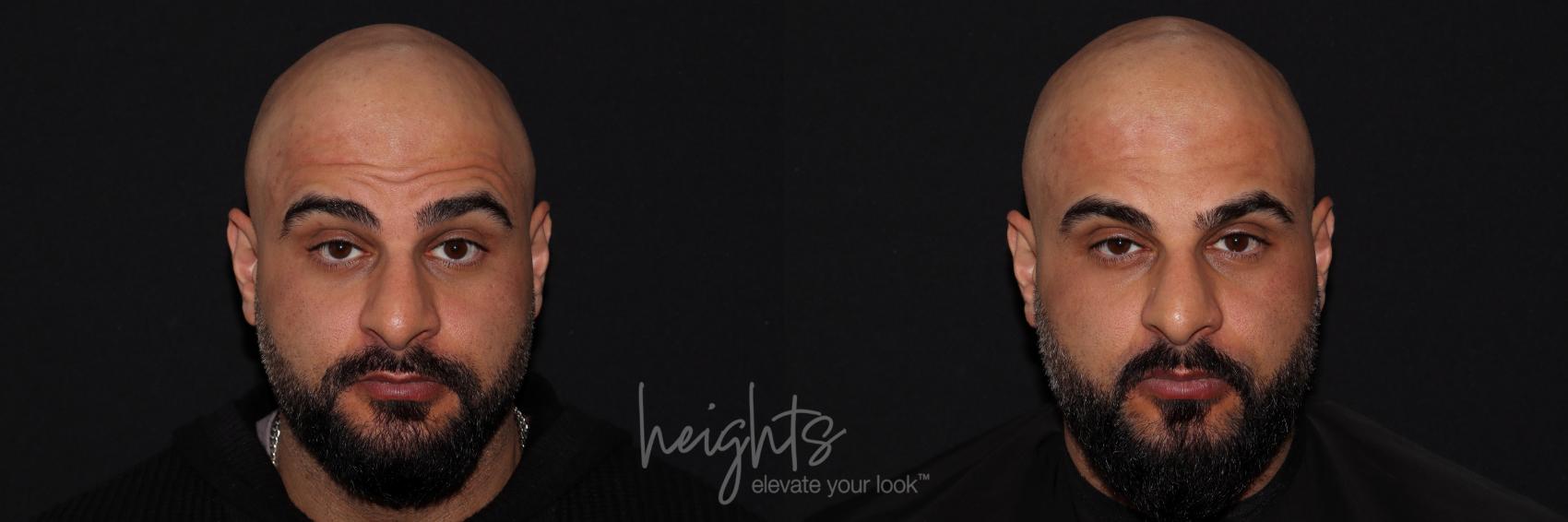 Before & After BOTOX COSMETIC® Case 139 Front View in Vancouver (Burnaby), BC