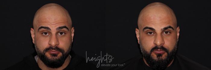 Before & After BOTOX COSMETIC® Case 139 Front View in Vancouver (Burnaby), BC