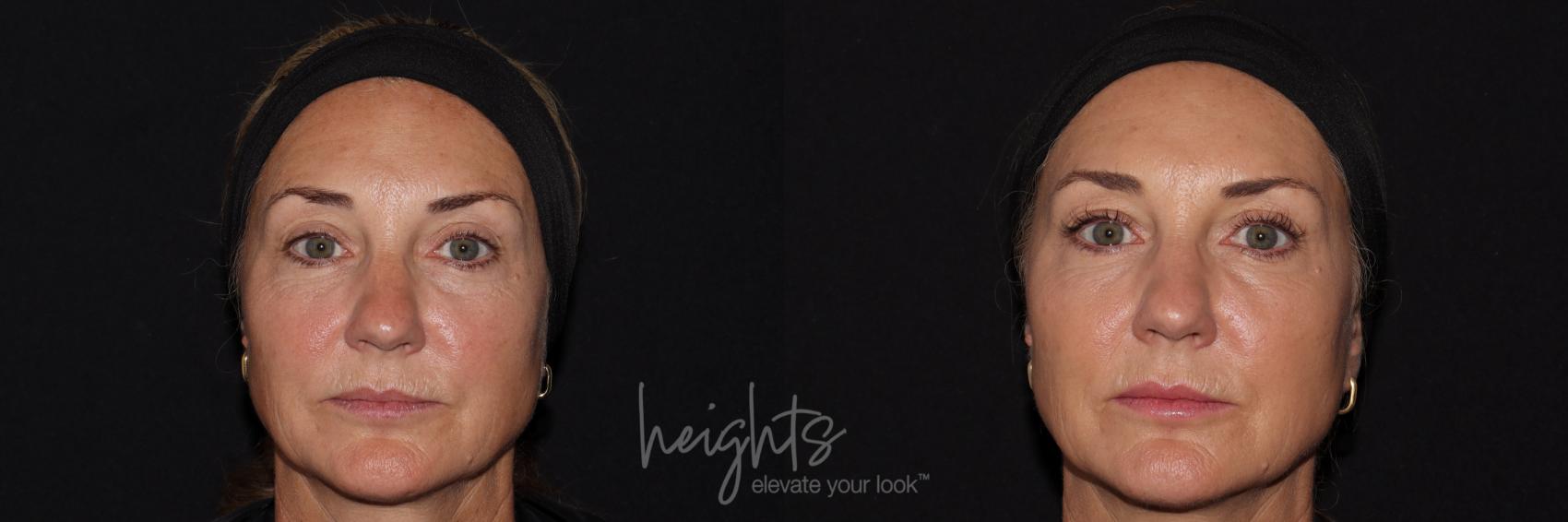 Before & After BOTOX COSMETIC® Case 141 Front View in Vancouver (Burnaby), BC
