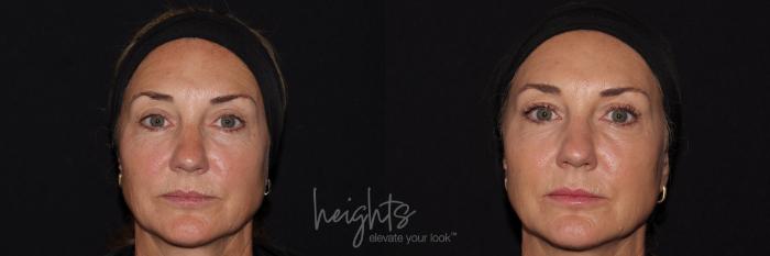 Before & After BOTOX COSMETIC® Case 141 Front View in Vancouver (Burnaby), BC