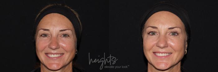 Before & After BOTOX COSMETIC® Case 141 frontal crows feet View in Vancouver (Burnaby), BC