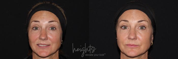 Before & After BOTOX COSMETIC® Case 141 frontal eyebrows up View in Vancouver (Burnaby), BC