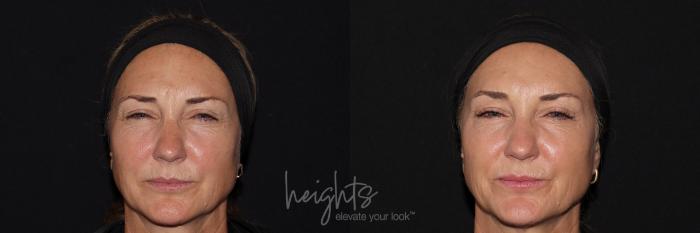 Before & After BOTOX COSMETIC® Case 141 Frontal frown View in Vancouver (Burnaby), BC