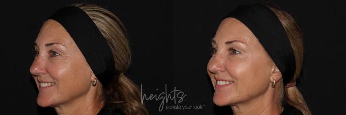 Before & After BOTOX COSMETIC® Case 141 left oblique crows feet View in Vancouver (Burnaby), BC