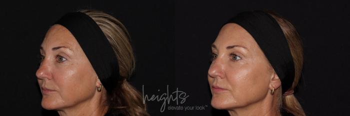 Before & After BOTOX COSMETIC® Case 141 Left Oblique View in Vancouver (Burnaby), BC