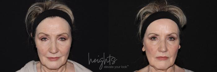 Before & After BOTOX COSMETIC® Case 142 Front View in Vancouver (Burnaby), BC