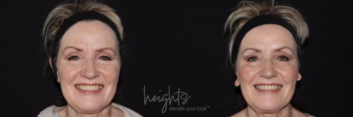 Before & After BOTOX COSMETIC® Case 142 frontal crows feet View in Vancouver (Burnaby), BC