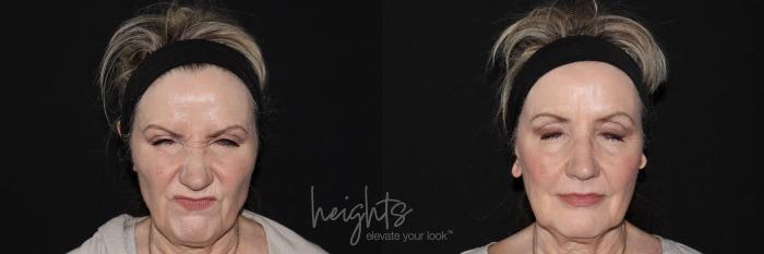 Before & After BOTOX COSMETIC® Case 142 Frontal frown View in Vancouver (Burnaby), BC