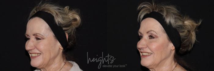 Before & After BOTOX COSMETIC® Case 142 left oblique crows feet View in Vancouver (Burnaby), BC