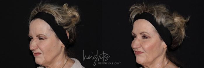 Before & After BOTOX COSMETIC® Case 142 Left Oblique View in Vancouver (Burnaby), BC
