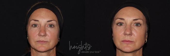 Before & After BOTOX COSMETIC® Case 145 Front View in Vancouver (Burnaby), BC