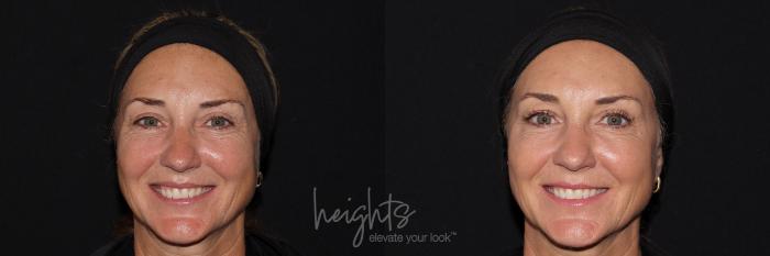 Before & After BOTOX COSMETIC® Case 145 frontal crows feet View in Vancouver (Burnaby), BC
