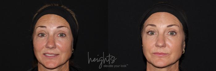 Before & After BOTOX COSMETIC® Case 145 frontal eyes up View in Vancouver (Burnaby), BC