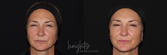 Before & After BOTOX COSMETIC® Case 145 Frontal frown View in Vancouver (Burnaby), BC