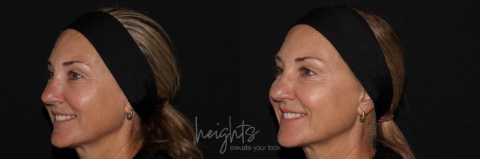 Before & After BOTOX COSMETIC® Case 145 Left Oblique View in Vancouver (Burnaby), BC
