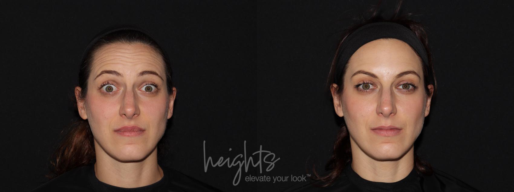 Before & After BOTOX COSMETIC® Case 77 Front View in Vancouver (Burnaby), BC