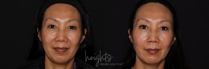 Before & After Dermal Fillers Case 156 Front View in Burnaby & Vancouver, BC