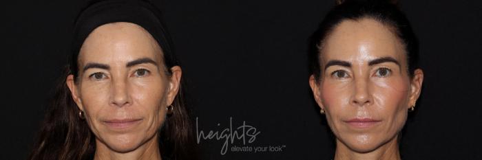 Before & After Dermal Fillers Case 157 Front View in Burnaby & Vancouver, BC