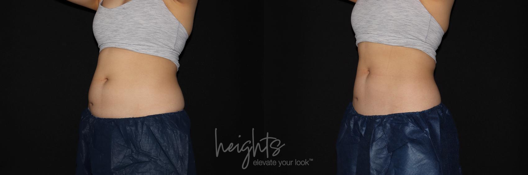 Before & After EMSCULPT NEO® Case 128 Left Oblique View in Vancouver (Burnaby), BC