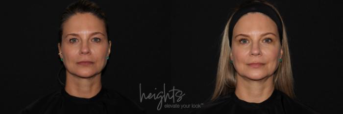 Before & After Eyelid Surgery Case 122 Front View in Vancouver (Burnaby), BC