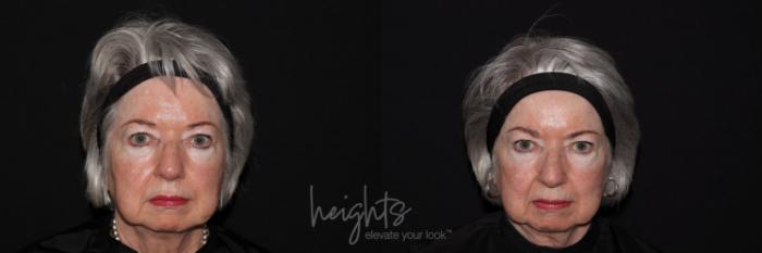 Before & After Glacial® fx Case 135 Front View in Vancouver (Burnaby), BC