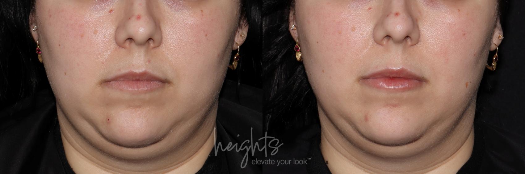 Before & After Lip Filler—Love Your Lips™ Case 129 Front View in Vancouver (Burnaby), BC
