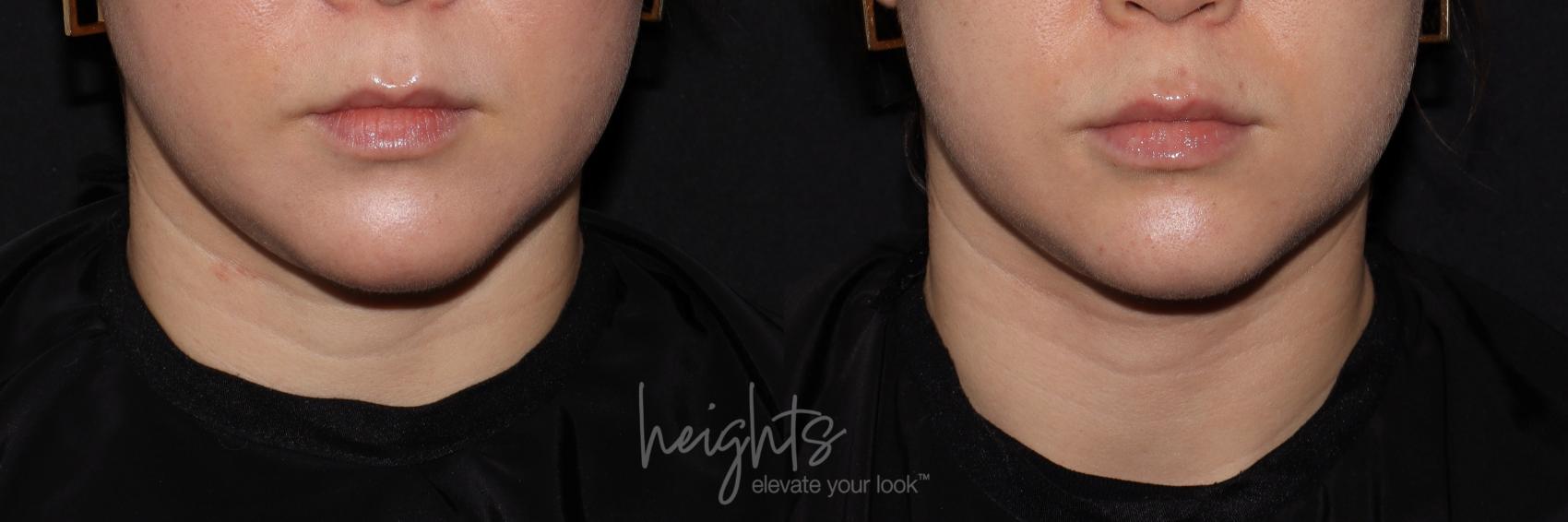 Before & After Lip Filler—Love Your Lips™ Case 133 Front View in Vancouver (Burnaby), BC