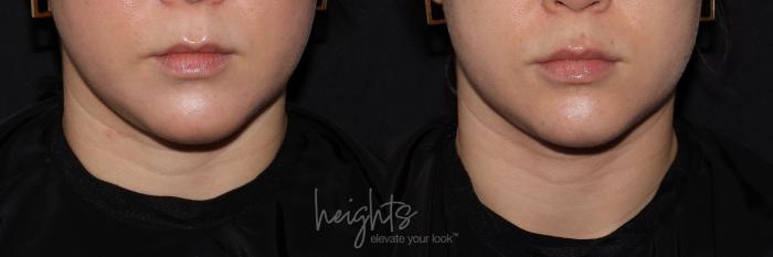 Before & After Lip Filler—Love Your Lips™ Case 133 Front View in Vancouver (Burnaby), BC
