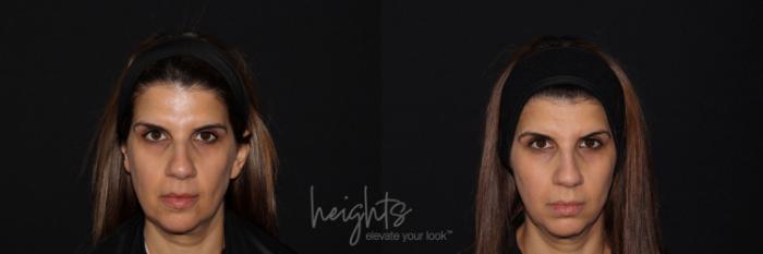 Before & After Liquid Facelift Case 130 Front View in Vancouver (Burnaby), BC