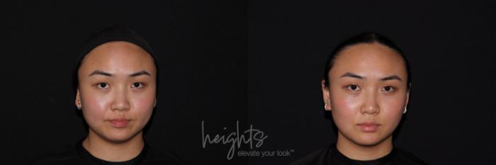Before & After Belkyra™ Double Chin Treatment Case 121 Front View in Vancouver (Burnaby), BC