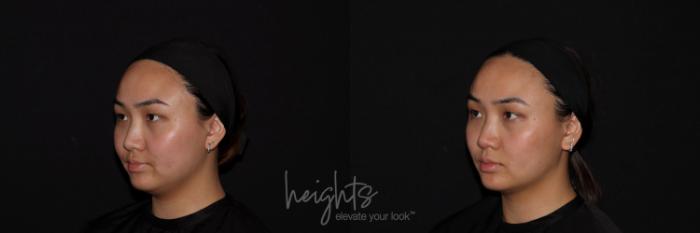 Before & After Belkyra™ Double Chin Treatment Case 121 Left Oblique View in Vancouver (Burnaby), BC