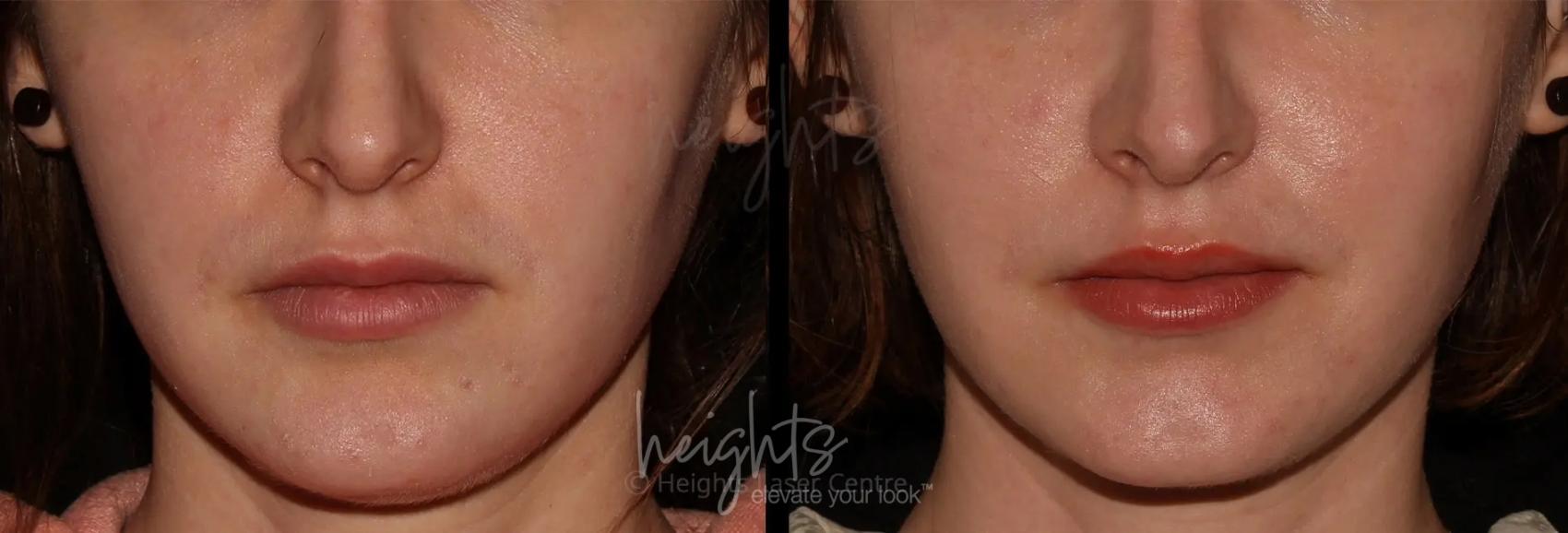 Before & After Belkyra™ Double Chin Treatment Case 18 Front View in Vancouver (Burnaby), BC