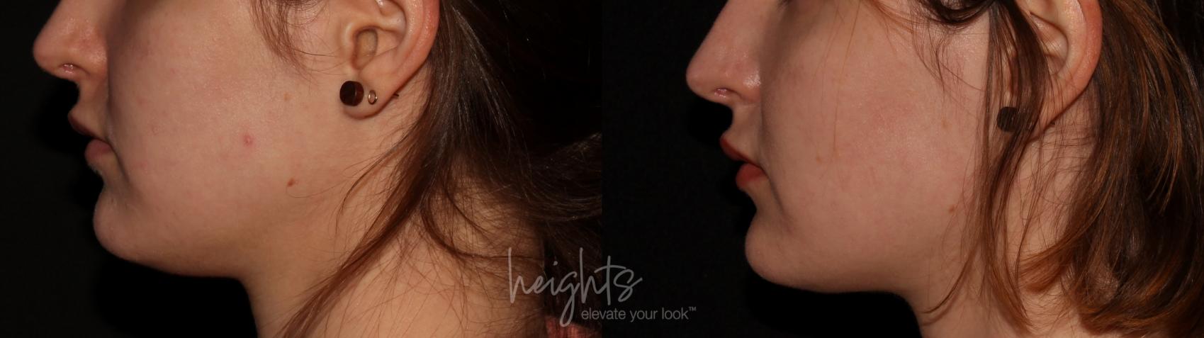 Before & After Belkyra™ Double Chin Treatment Case 75 Left Side View in Vancouver (Burnaby), BC
