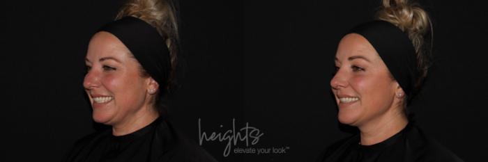 Before & After BOTOX COSMETIC® Case 125 Left Oblique View in Vancouver (Burnaby), BC