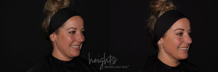 Before & After BOTOX COSMETIC® Case 125 Right Oblique View in Vancouver (Burnaby), BC