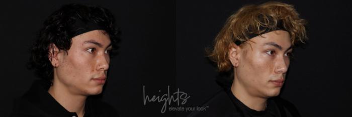 Before & After BOTOX COSMETIC® Case 126 Right oblique clenching View in Vancouver (Burnaby), BC