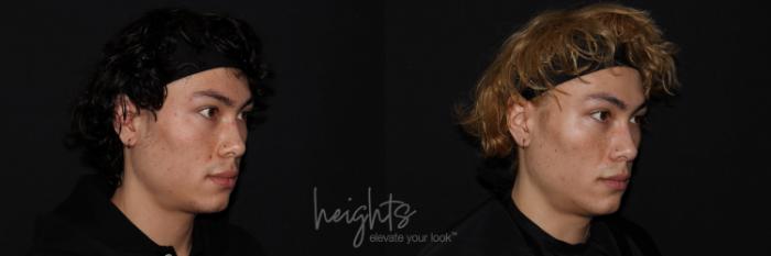 Before & After BOTOX COSMETIC® Case 126 Right Oblique View in Vancouver (Burnaby), BC