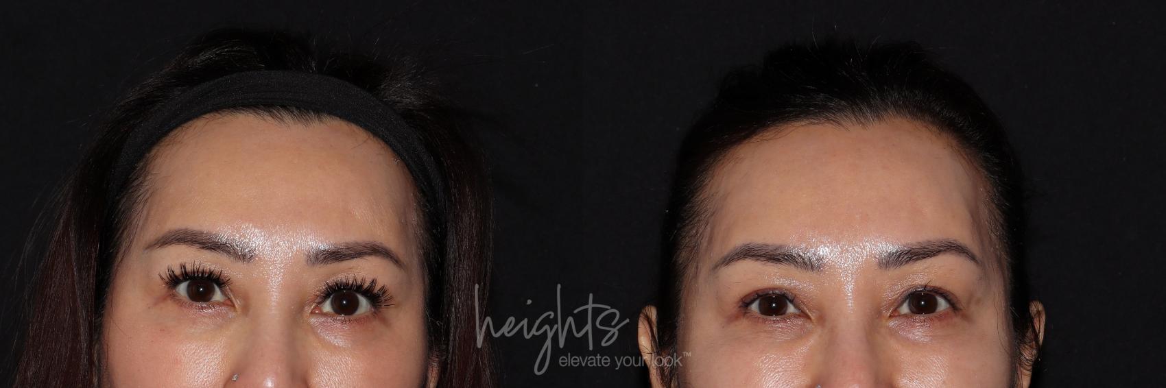 Before & After BOTOX COSMETIC® Case 132 Front View in Vancouver (Burnaby), BC