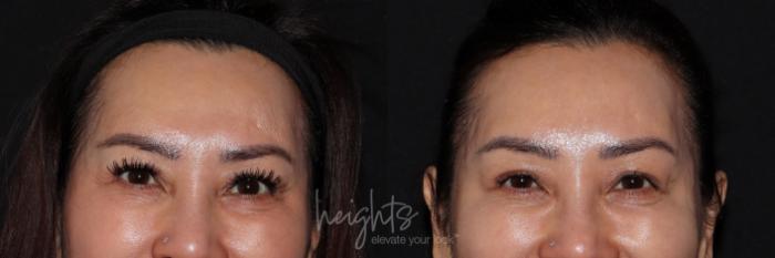 Before & After BOTOX COSMETIC® Case 132 frontal crows feet View in Vancouver (Burnaby), BC