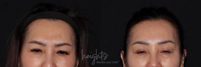 Before & After BOTOX COSMETIC® Case 132 Frontal frown View in Vancouver (Burnaby), BC
