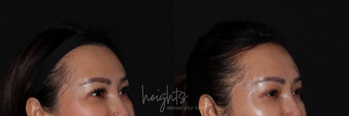 Before & After BOTOX COSMETIC® Case 132 right oblique crows feet View in Vancouver (Burnaby), BC