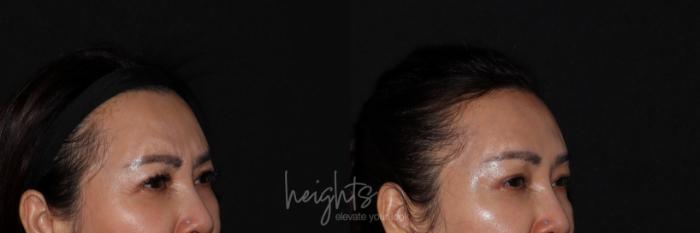 Before & After BOTOX COSMETIC® Case 132 Right Oblique View in Vancouver (Burnaby), BC