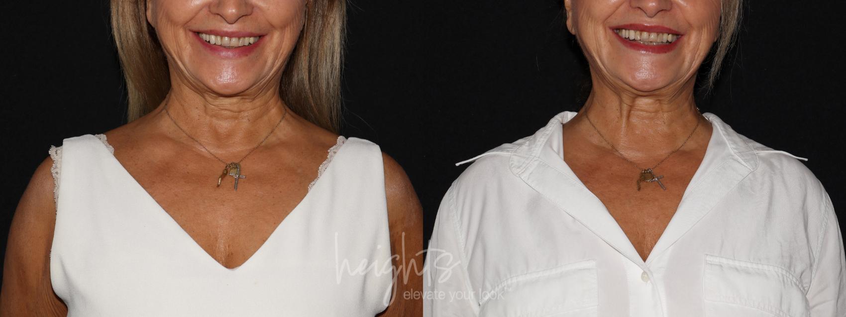 Before & After BOTOX COSMETIC® Case 136 Front View in Vancouver (Burnaby), BC