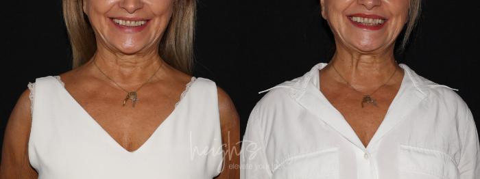 Before & After BOTOX COSMETIC® Case 136 Front View in Vancouver (Burnaby), BC