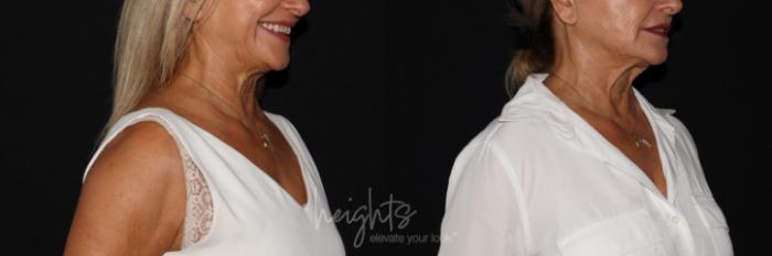 Before & After BOTOX COSMETIC® Case 136 Left Oblique View in Vancouver (Burnaby), BC
