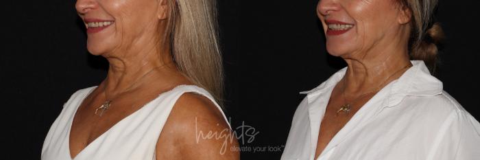 Before & After BOTOX COSMETIC® Case 136 Right Oblique View in Vancouver (Burnaby), BC