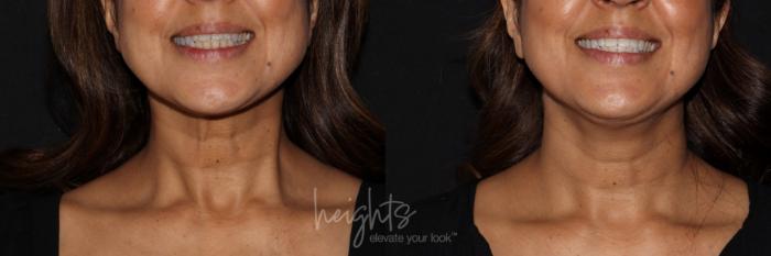 Before & After BOTOX COSMETIC® Case 137 Front View in Vancouver (Burnaby), BC