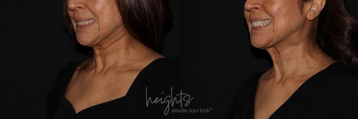Before & After BOTOX COSMETIC® Case 137 Left Oblique View in Vancouver (Burnaby), BC